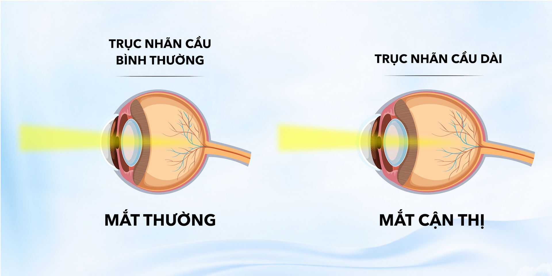 Cấu trúc chiều dài nhãn cầu của mắt cận
