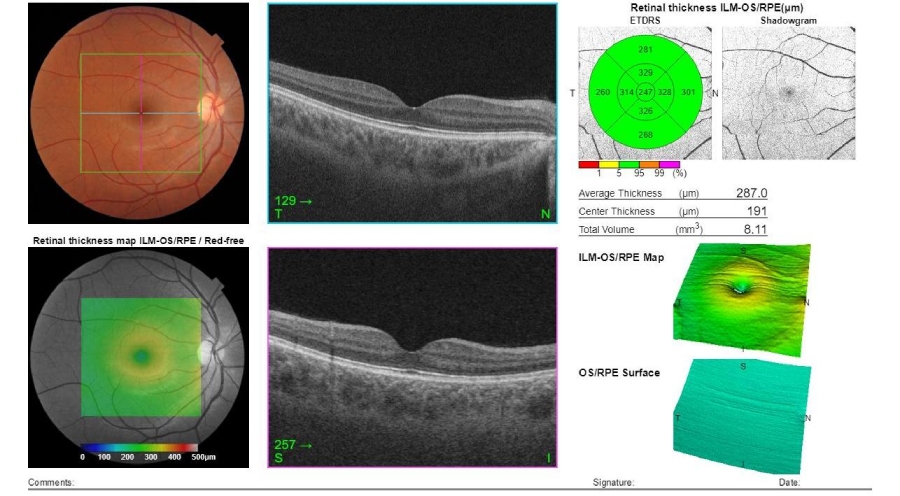 Chụp cắt lớp võng mạc mắt để làm gì?